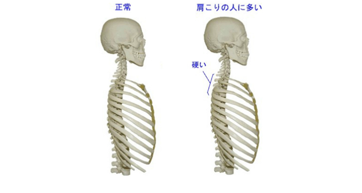 マットレスが原因の背中の痛み